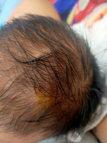 bakit at ano kaya tong nasa ulo ng baby ko mg mumsh