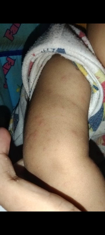 Merah pada bayi