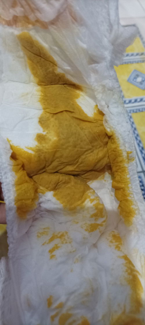 BAB Cair bayi usia 2 bulan