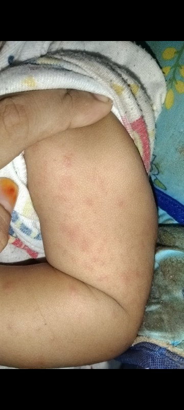 Merah pada bayi