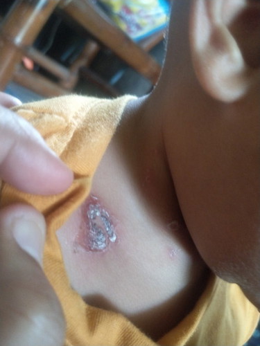 Skin rash na nagsimula sa bungang araw lang