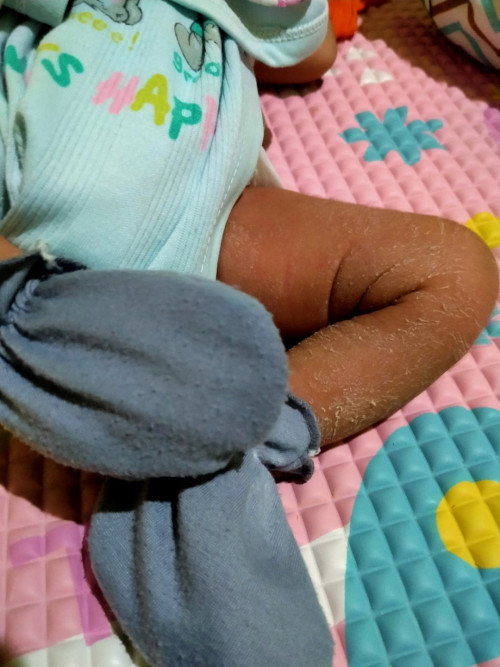 Kulit bayi mengelupas