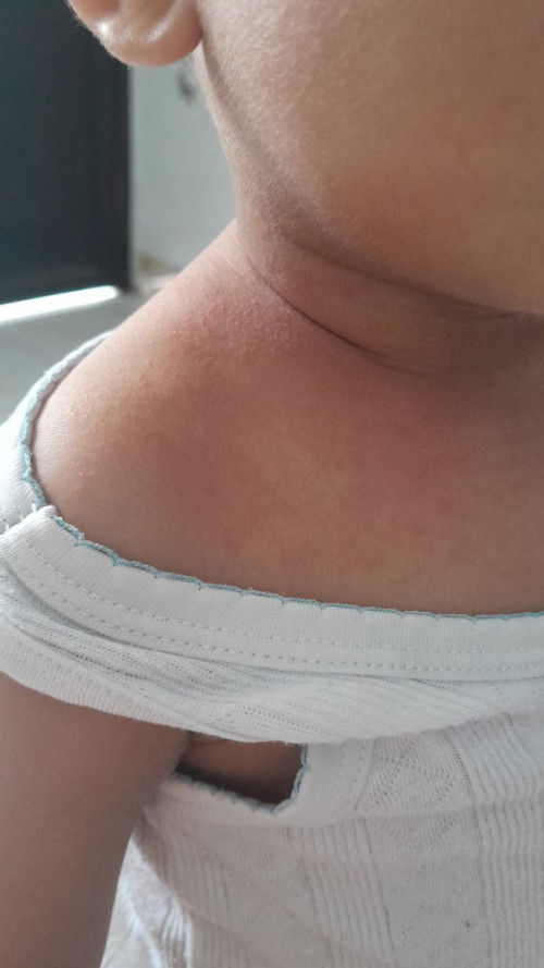 Ruam kemerahan karna panas