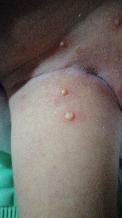 Mga mommy, nagkaroon na ba nito ang baby nyo? Ano po  gamot dito for my 2 week old baby?