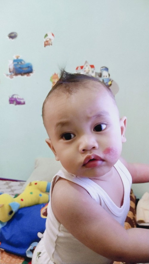 Kemerahan di pipi yg susah hilang,