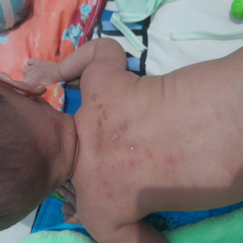 Bagi tips bunda,untuk anak saya yg gatal spt itu.obat apa yg ampuh???