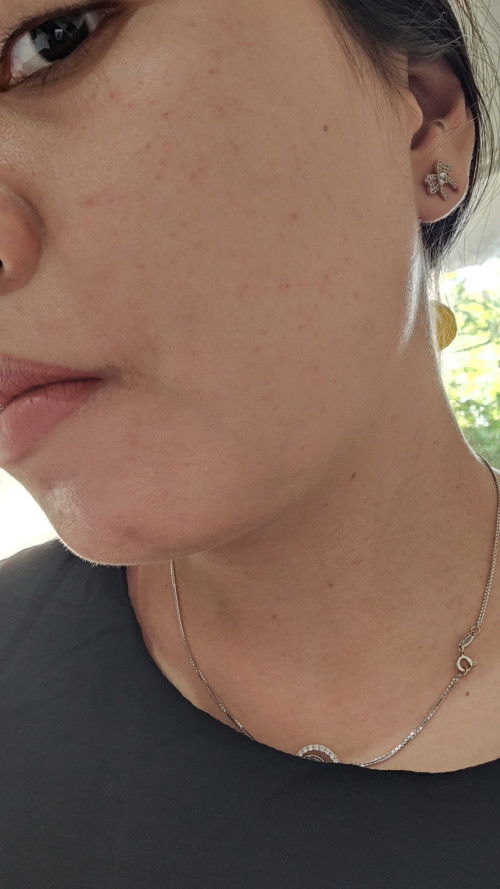 Masalah kulit saat hamil