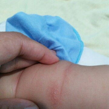 Bintik bintik ditangan