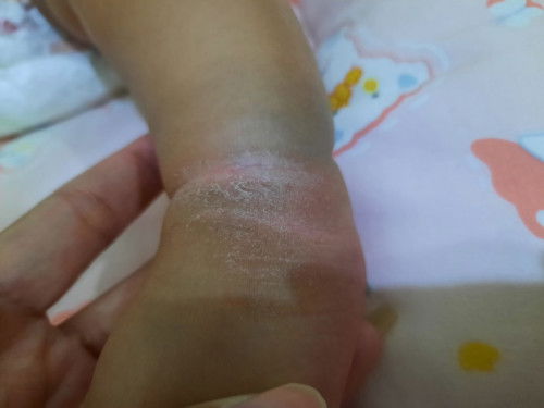 ข้อขาน้องหนังดำลอก ใช้อะไรทาหาคะ