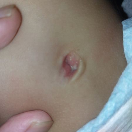 White discharge on baby navel