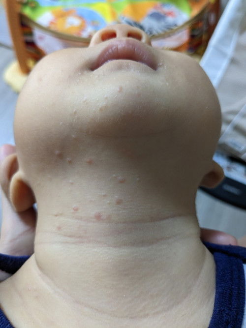 Bumps on baby
