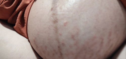 Stretchmark Gatal dan Perih
