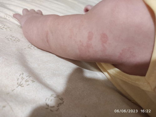 kulit bayi ruam merah
