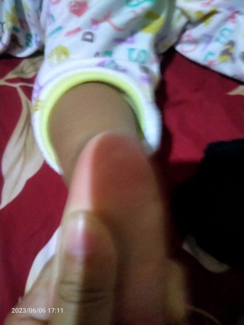 Ada benjolan putih ditelapak kaki penyebabbya apa ya sama cara nyembuhinnya gmna? Tiap ditekan anak