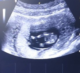 ช่วยทายเพศลูกจากภาพซาวด์หน่อยค่ะ อายุครรภ์ 12 สัปดาห์