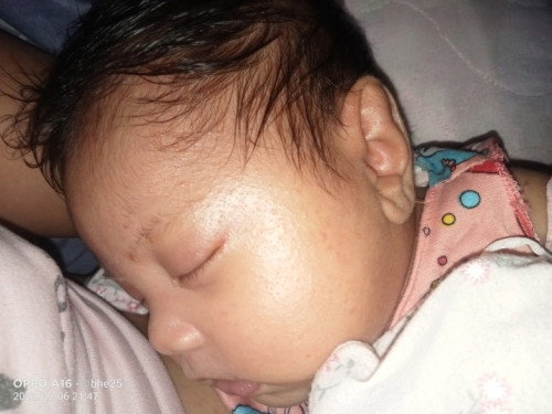 Ano po Ang pwedeng gamot Kay baby yong rashes Niya sa mukha Hanggang sa ulo at leeg na tapos hindi s
