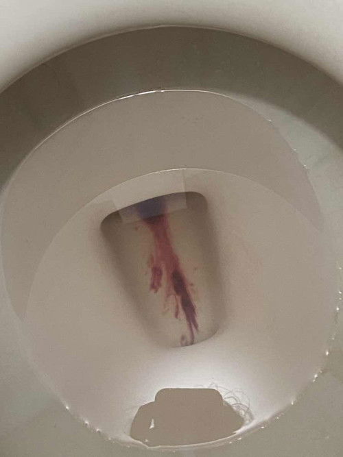 เลือดออกทางช่องคลอดตอน 9+1