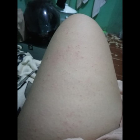 Pregnancy rashes