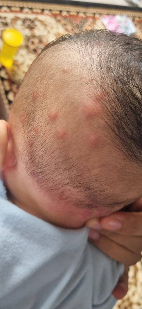 Kepala bayi bengkak2