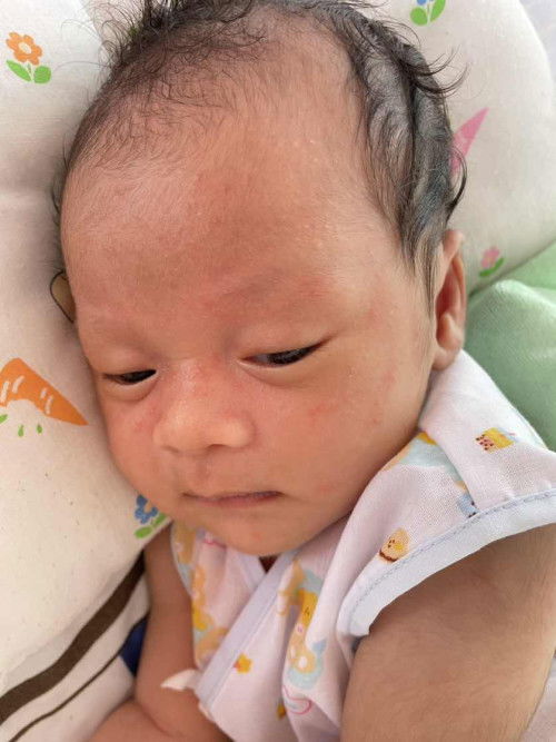 ผดผื่นแดงบนหน้า