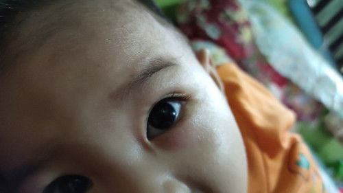 Demam dan keluar biang keringat