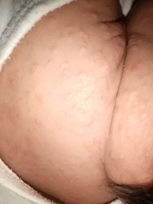 Ano po kaya pwedeng pang gamot dito or natural lang poba to sa baby mawawala din poba ito?