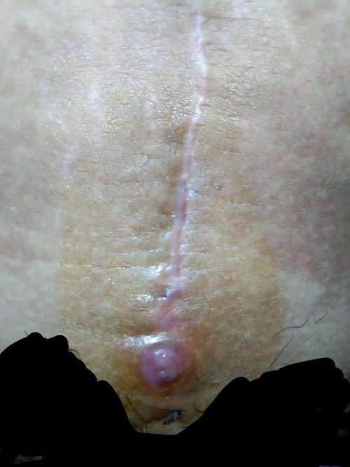 CS wound...