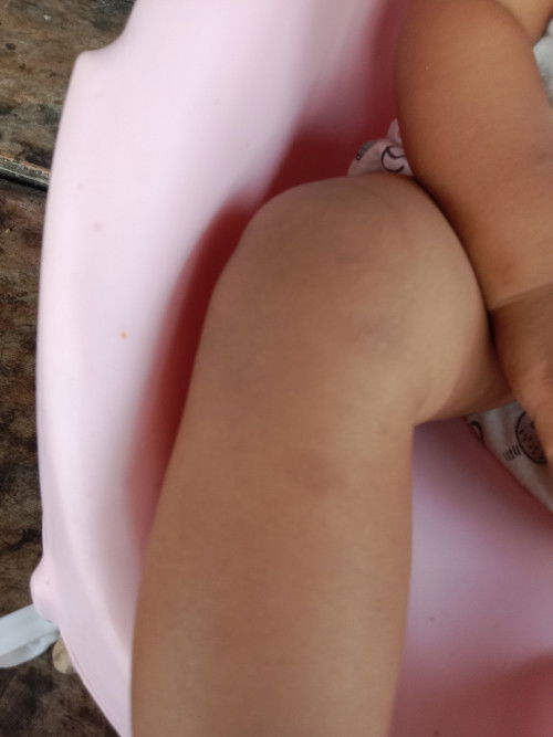 รอยดำรอยยุงกัดรักษายังไง