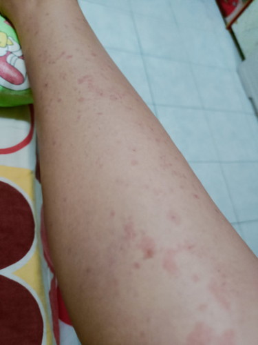 sino po may ganito,pati po sa tummy madami. 34weeks pregnant. sedazone at Frednisone 70mg reseta po