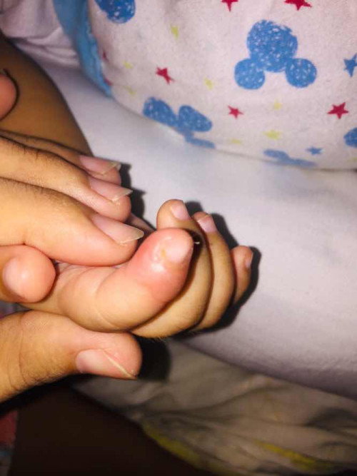 hello po mga moms pa help naman po kung anong pwede ilagay or gamot dto sa daliri ni baby🥺😌