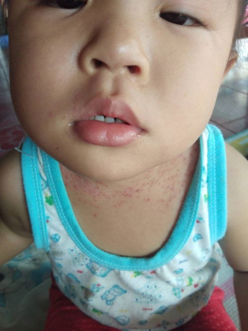 ผื่นขึ้น ต้องใช้ยาตัวไหนถึงจะหายคะ