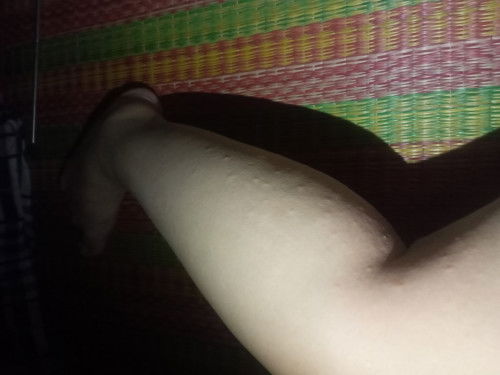 34w mà bị như này ko ạ