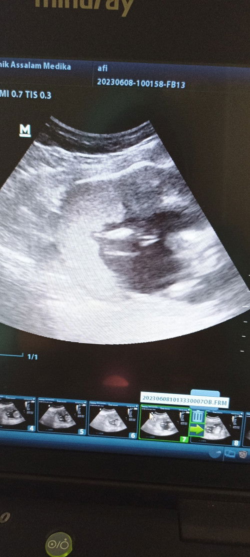 32 tahun hamil ke 2 cewek lagi