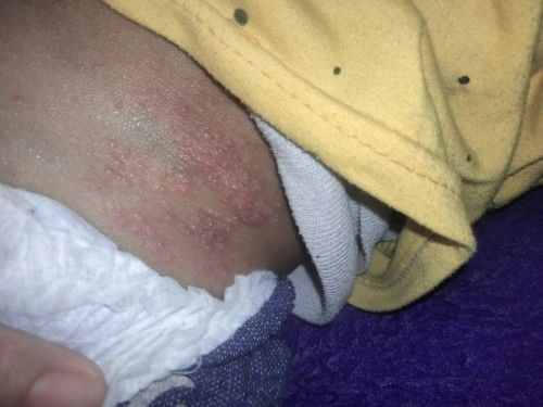 Gatal pada kulit bayi