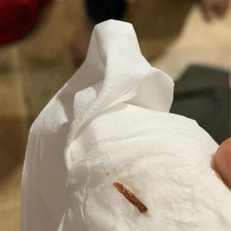 Flek saat hamil 5minggu