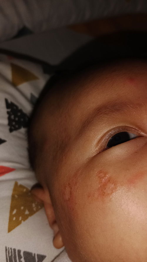 Halo bun, mau tanya ini pipi anak ku knp yah?