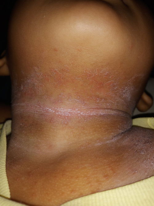 Obat medis atau herbal utk gatal kulit.