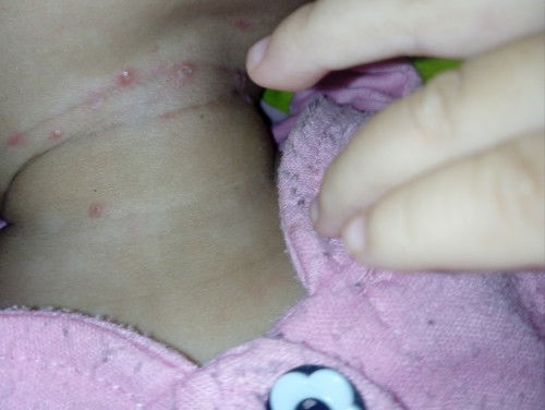 Merah merah di kulit