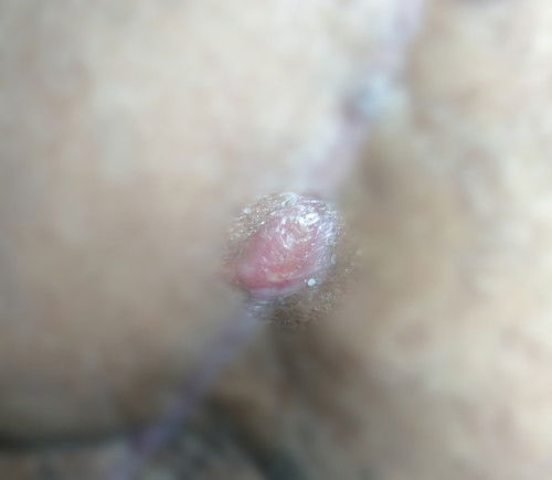 Benjolan Dibekas jahitan SC