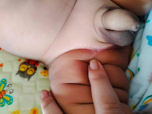 น้อง2เดือน เป็นผื่นผ้าอ้อม แบบนี้แพ้ยาทาหรือป่าวคะ