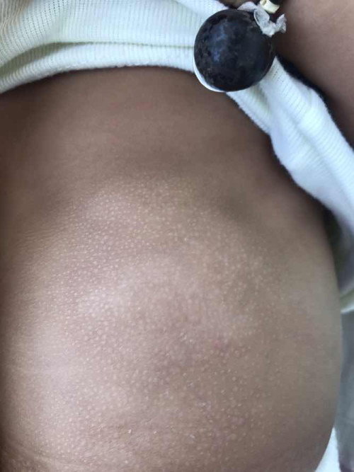 Muncul bintik bintik