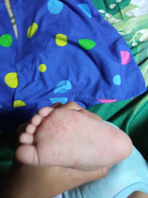 Mengatasi gatal bayi