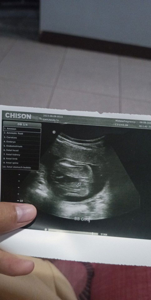 Sure na ba na girl to mga mhie?