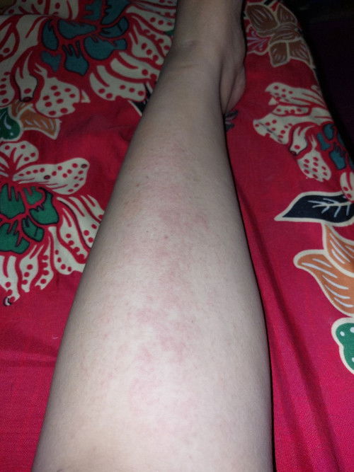 Gatal Kaki Saat Hamil Trimester 3