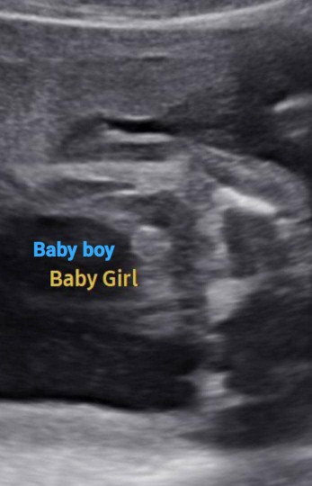 Boy or girl?