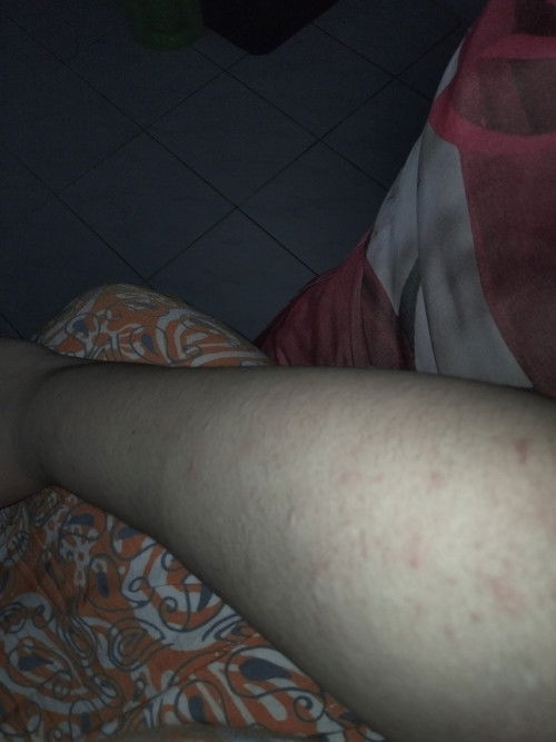 Alergi (gatal-gatal)