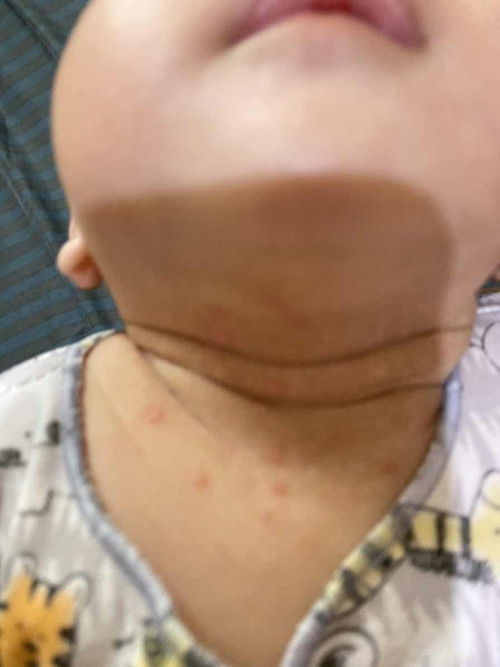 Merah bulat pada leher bayi 3 bulan