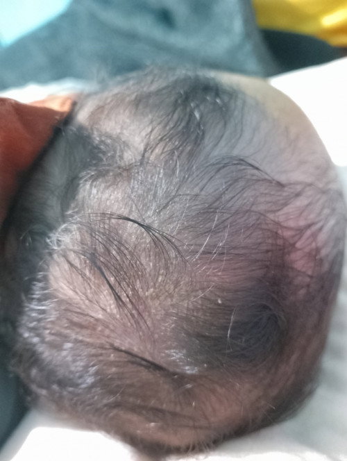Ketombe kulit kepala bayi