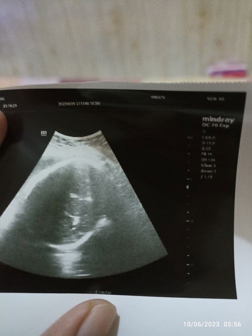 Air ketuban keruh dan sudah mulai berkurang. Hpl USG 5 Juni hpl hpht 21 juni