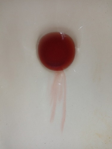 Normal pa po ba kung ganito pa rin bleeding, nag start po ng may 17 until now meron pa rin po.